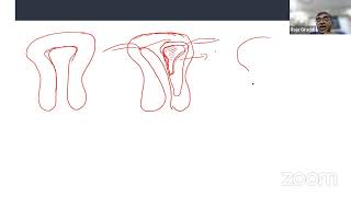 Mullerian Anomalies 2D and 3D Diagnosis By DrRaju Giraddi [upl. by Bellina]