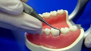 Posterior Dental Scaling video 204S BH56 [upl. by Warfeld]