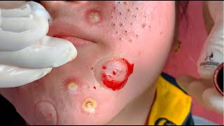 Dermatologists Secrets to Clear Healthy Skin The Ultimate Blackhead Removal 11 [upl. by Lihp]