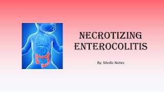 Necrotizing enterocolitis  definition clinical features investigations management [upl. by Assennev]