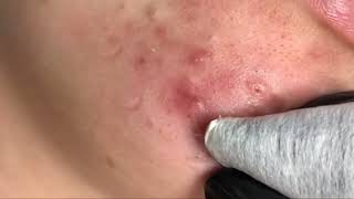 how to remove blackheads from nose and face  blackheads remover removeblackhead [upl. by Magdaia587]