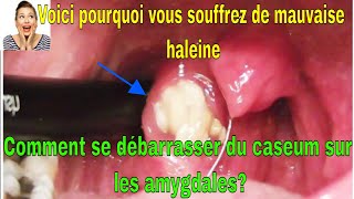 Voici pourquoi vous souffrez de mauvaise haleine Comment se débarrasser du caseum sur les amygdales [upl. by Amitaf]