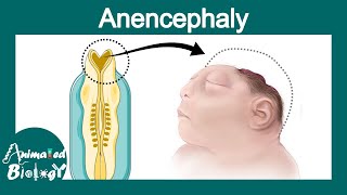 Anencephaly  Neural tube defects  folate deficiency  USMLE [upl. by Edi]