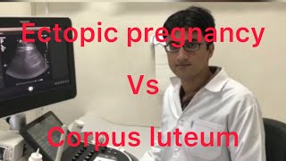 Sonography ectopic pregnancy vs corpus luteum [upl. by Elvyn963]