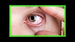 Wussten Sie dass Rheumatoide Arthritis die Augen beeinträchtigen kann [upl. by Alistair148]