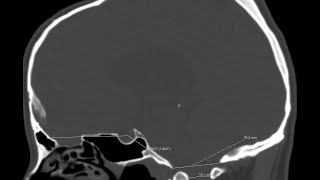 Basilar platybasia and invagination or impression in a case with chronic hydrocephalus [upl. by Reinke342]