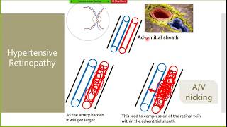 Hypertensive Retinopathy PathophysiologyPart 1 [upl. by Ayeka824]