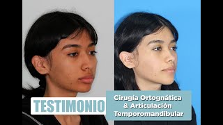 TestimonioCirugía Ortognática [upl. by Neelrahs430]