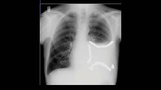 Chest Xray in Pleural Effusion How to Explain the findings [upl. by Chastain640]