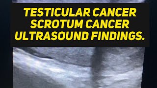 Testicular cancer ultrasound suspected case [upl. by Aicenert751]