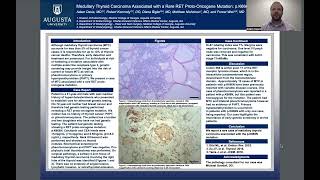 Medullary Thyroid Carcinoma Associated with a Rare RET ProtoOncogene Mutation pK666N [upl. by Granese]