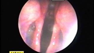 Abnormal Layngeal FunctionLaryngeal Paralysis [upl. by Megen]