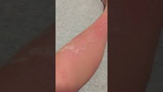 Skin Peeling from Sunburn asmr [upl. by Golightly]