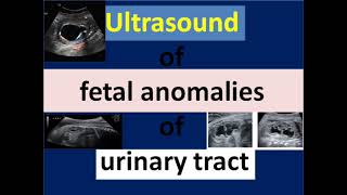 Ultrasound of fetal anomalies of urinary tract [upl. by Alrahs]