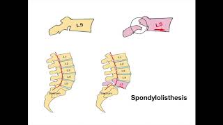 Spondylolisthesis [upl. by Conny]