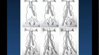 Internal Iliac Artery Embolization by Joseph Hart MD Part 2 [upl. by Latea]