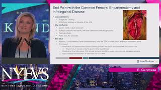 Concomitant CFA and Iliac or SFA Disease Should I Treat Both – Hybrid vs Endo Elizabeth Genoves [upl. by Cyrille]