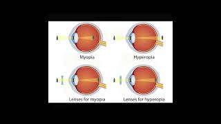 Anisometropia  Symptoms and Causes  Diagnosis  Treatment  Prevention healthcare eyes [upl. by Nagah911]