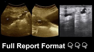 Soft tissue infection  Bilateral hydrosalpinx  Ultrasound  Report  Amader hospital [upl. by Tubb]