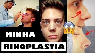 VLOG  MINHA RINOPLASTIA CIRURGIA NO NARIZ  PÓS OPERATÓRIO 24 [upl. by Konstantine]