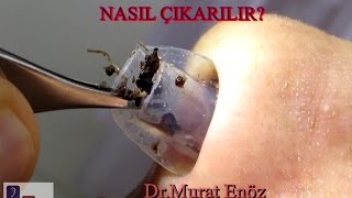 Silikon Burun Tamponu Nasıl Çıkarılır Nasal Splint Removal [upl. by Kneeland]