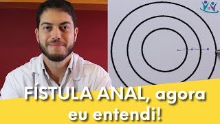 Fístula anal explicada de um jeito fácil de entender  Dr Marcelo Werneck [upl. by Eened]