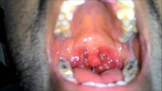 Acute Tonsillitis with Tonsillar exudates [upl. by Ikkiv]