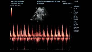 frecuencia cardiaca fetal paciente betzabe velazco zavala [upl. by Einttirb]