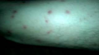 Chiggers Attacked on the 4th of July [upl. by Fleck430]