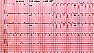 Ventricular Arrythmias and Sudden Cardiac Death  Presentation [upl. by Attenaz42]