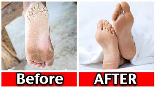 10 Ways To ELIMINATE Dry Cracked Feet And Heels [upl. by Nolahc236]