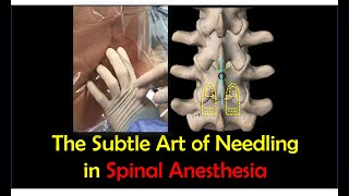 LandmarkGuided Midline Spinal Anesthesia StepbyStep Technique [upl. by Yrffoeg380]