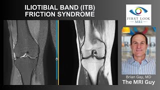 ILIOTIBIAL BAND ITB FRICTION SYNDROME [upl. by Dranik]