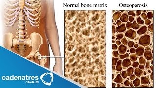 ¿Qué es la Osteoporosis  Cómo prevenir la osteoporosis [upl. by Enitsahc]