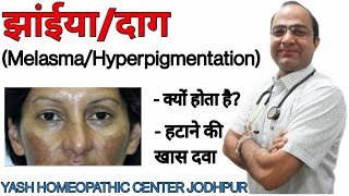 Melasma Hyperpigmentation treatment चेहरे पर झाँईंया दाग धब्बे का घरेलू होमीओपैथिक ईलाज [upl. by Mosira858]