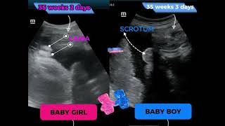 Baby Boy  Baby girl  both at 35 Weeks  ultrasound [upl. by Anilos]