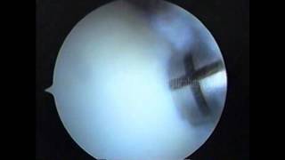 Knee arthroscopy  OCD Mosaicplasty [upl. by Atirihs247]