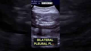 Ultrasound FETAL HYDROPS  20wks Pregnancy [upl. by Nirag]