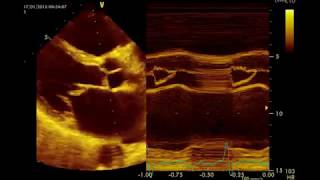 Insuffisance mitrale Sévère par rupture de cordagequotMitral Prolapsequot القصور التاجي الحاد [upl. by Llertrac232]