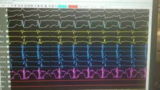 SVT differentiating AVNRT VS AVRT VS ATRIAL TACH [upl. by Bettina415]