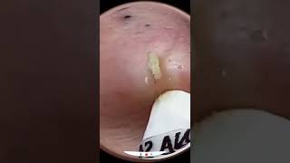 Blackheads Removal  Acne Treatment and Very Satisfying Satisfying Pimple pop blackheads [upl. by Ennairac]