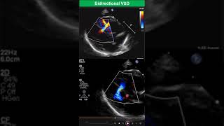 Bidirectional Ventricular Septal Defect Early Stage of Eisenmenger Syndrome [upl. by Zeuqram]