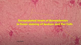 Acinetobacter in clinical sample Sputum Gram stain Microscopy at various magnifications [upl. by Nyliram]