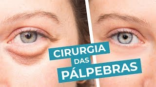 CIRURGIA DAS PÁLPEBRAS ou BLEFAROPLASTIA para tirar aparência de cansaço [upl. by Miarhpe316]