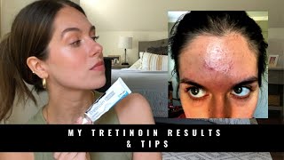 MY TRETINOIN RESULTS amp TIPS  Rudi Berry [upl. by Anaili]