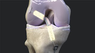 Arthrex BioACL™ Technique [upl. by Wenz]