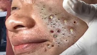 Big Cystic Acne Blackheads Extraction Blackheads amp Milia Whiteheads Removal Pimple Popping  701 [upl. by Odranreb]