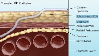 Complications of Peritoneal Dialysis by S Su  OPENPediatrics [upl. by Asirap789]