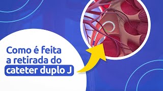 Como Retiramos o Cateter de Duplo J  O que todo mundo deveria saber antes da cirurgia [upl. by Krasnoff]