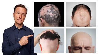 The 11 Types of Alopecia AND HOW TO FIX IT  Dr Berg [upl. by Moreta]